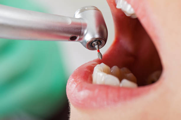 Best Lost Filling or Crown Replacement in Merrydale, LA